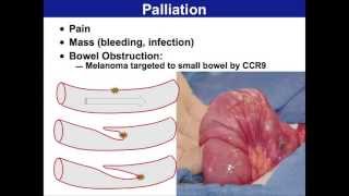 Surgery for Malignant Melanoma  Melanoma Education Symposium Mark Faries MD [upl. by Mikael233]