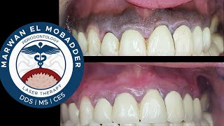 Tips for a Successful Gingival Depigmentation [upl. by Magdala]