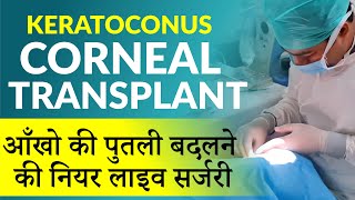 Corneal Transplant  Near LIVE Surgery  आँखो की पुतली बदलने की सर्जरी  Keratoconus Treatment [upl. by Llednohs]