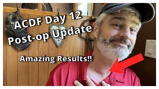 ACDF Miracle Recovery Day 12 Tips and What To Expect [upl. by Nymassej]