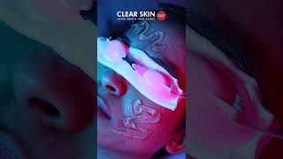 IPL for Acne Reducing Inflammation Bacteria and Hyperpigmentation  Clear Skin Pune [upl. by Crawford]