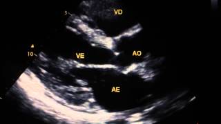 Disfuncao ventricular moderada  fe 40 [upl. by Anaibib]