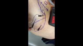 Electrical Dry Needling to Trigger Points in the Gluteus Medius and Minimus Muscles [upl. by Leler]