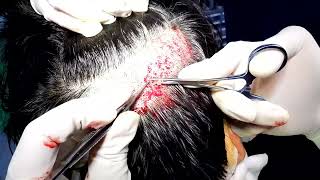 Novel follicular unit excision device in FUE surgery  Supplementary video 2 ID 416257 [upl. by Anelehs]