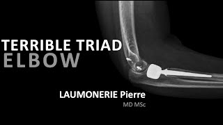 Terrible triad injury of the elbow  Terrible triade du coude  par le Dr Laumonerie [upl. by Cinderella]