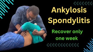 Ankylosis Spondylitis Recover Only One Week ankylosing spondylitis symptoms treating ankylosing [upl. by Barmen]