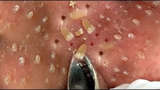 Best Satisfying Nose Plucking Blackheads Whiteheads Removal  Acne Treatment 14 [upl. by Slemmer]