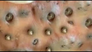 20 Biggest blackheads removed by pinching and squeezing by an expert [upl. by Ranger]