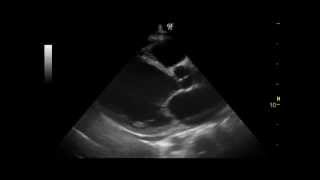 Dilated Cardiomyopathy  QMH AED Ultrasound Casebook 201203 Video 1 [upl. by Ellecrad]