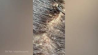 Professional headlice remover shares the worst nits shes ever treated [upl. by Cir]