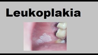 Leukoplakia [upl. by Boggs956]