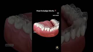 Orthodontic treatment 🦷 dentistdentaltreatment malocclusionorthodontist aligmentbeautifulsmile [upl. by Ekihc]