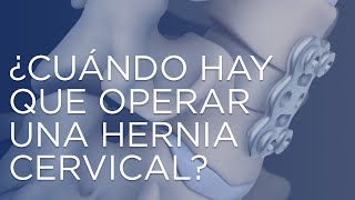 ¿Cuándo hay que operar una hernia cervical [upl. by Yug]