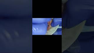 Tapping test for lower molar dental implants after 6 months shorts [upl. by Naima894]