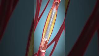 procedure of angioplasty shorts viralshorts [upl. by Bannon774]