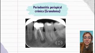 Lesiones periapicales [upl. by Vanhomrigh717]