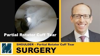 Shoulder Pain  Partial Rotator Cuff Tears [upl. by Louth]