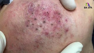 Relax everyday with spa 300 Popping huge blackheads and Pimple Popping  Best Pimple Popping Videos [upl. by Laenej919]