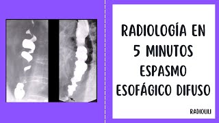 Radiología en 5 minutos Espasmo Esofágico Difuso [upl. by Akimed]