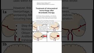 Treatment of intracerebral hemorrhage after thrombotic therapy [upl. by Aissert307]