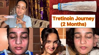 2 Month RetinolTretinoin Journey✨ [upl. by Yrrem960]