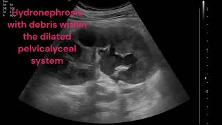 RIGHT PYELONEPHRITIS WITH PYONEPHROSIS [upl. by Sinclare]