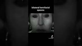 bilateral hemifacial spasms [upl. by Calondra854]