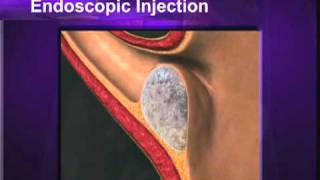 Vesicoureteral Reflux Education Video [upl. by Meensat]