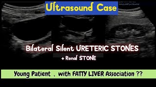 Bilateral Ureteric Silent Calculus  Fatty Liver Association [upl. by Ahsaret]