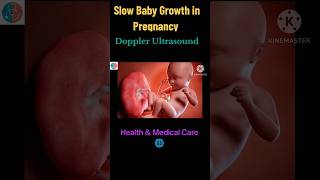 Slow Baby Growth in PregnancyRole Of Doppler Ultrasound baby preganacy doppler growth viral [upl. by Anael]