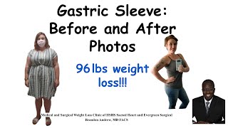 Gastric Sleeve Before and After Pictures and Results  Bariatric Weight Loss Surgery Journey Results [upl. by Bucky]