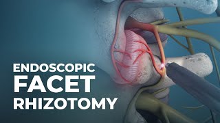 What is Endoscopic Facet Rhizotomy  AtlanticSpineCenter [upl. by Verna]