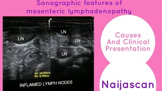 Abdominal Ultrasound  Mesenteric adenitis  Mesenteric lymphadenopathy  Abdominal pain in children [upl. by Oidualc]