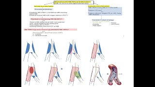 Coronary bifurcation stenting modern algorithms and details of provisional techniques Elias Hanna [upl. by Yelhs]