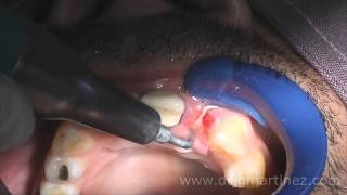 Atraumatic Tooth Removal of a 2nd Incisor with Piezotome LC1tip DrJuanMartinez [upl. by Nas]