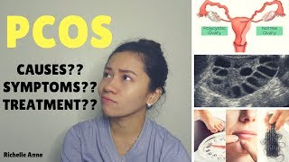 PCOS  Causes Symptoms Treatment  Tagalog [upl. by Amund]