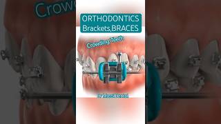 ORTHODONTICS Braces Brackets [upl. by Murrell215]