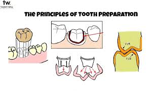 Principles of tooth preparation [upl. by Romo]