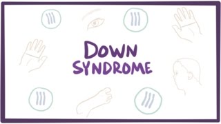 Down syndrome trisomy 21  causes symptoms diagnosis amp pathology [upl. by Adniralc54]