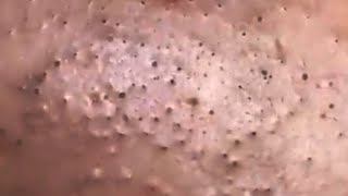 Blackheads amp Whiteheads Satisfying Removal 0034 [upl. by Faruq348]