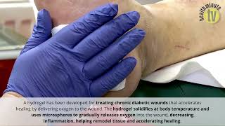 Hydrogel developed for accelerated diabetic wound healing [upl. by Picco]