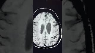 Significance of SWI  Superficial siderosis [upl. by Bobina]