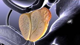 Prostate Cancer Animation [upl. by Culbertson]