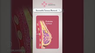 Massive Breast Phyllodes Tumor  Dr Rohan Khandelwal  Breast Cancer Surgeon [upl. by Lehcer]