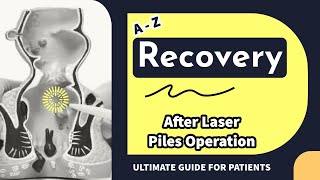 START TO END recovery POINTS after Laser Piles Operation  Laser Haemorrhoidoplasty [upl. by Hsur]