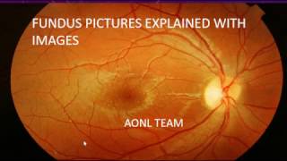 Fundus images explained by an ophthalmologist [upl. by Ardnalac]