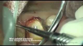 Gingival Retraction methods [upl. by Harmonia409]