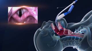 UE Video Laryngoscope Demo [upl. by Aicened]