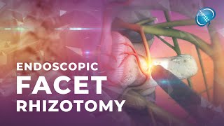 What is Endoscopic Facet Rhizotomy [upl. by Elleahcim]