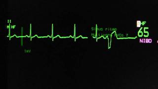 sinus rhythm with ventricular extrasystoles on an ECG monitor [upl. by Anyehs]